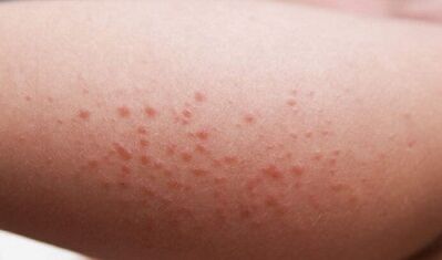 εξωτερικές εκδηλώσεις της παρουσίας παρασίτων στο σώμα